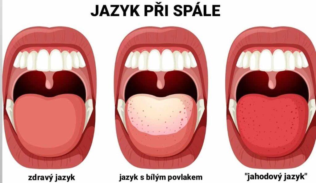 Spála - příznaky, u dospělých, dětí a v těhotenství - Vmagazin.cz